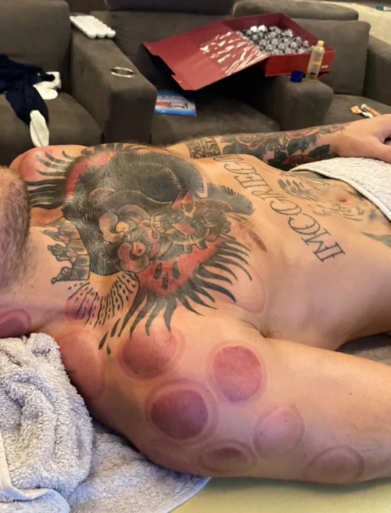 Why Do UFC (MMA) Fighters Do Cupping?